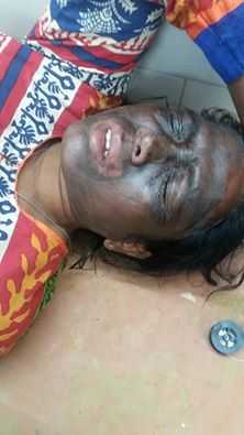 अंततः कल्लूरी ने अपना नापाक मंसूबा पूरा कर दिखाया : आदिवासियों के हक़ की लड़ाई लड़ रही सोनी सोरी पर केमिकल  हमला 