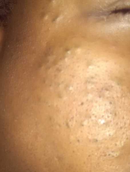 मुहासे , पिम्पल: दस जरुरी टिप्स हिंदी में