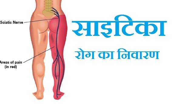 साइटिका रोग का निवारण सही इलाज और आसान उपाय