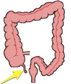 अपेंडिक्स का इलाज लक्षण और दर्द के 5 आसान घरेलू नुस्खे