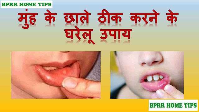 à¤®à¥à¤à¤¹ à¤®à¥à¤ à¤à¤¾à¤²à¥-Home Remedies For Mouth Ulcer In Hindi,