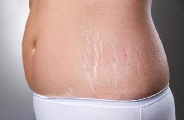 à¤¸à¥à¤à¥à¤°à¥à¤ à¤®à¤¾à¤°à¥à¤à¥à¤¸ à¤à¥à¤¸à¥ à¤¹à¤à¤¾à¤à¤ | How To Remove Stretch Marks In Hindi