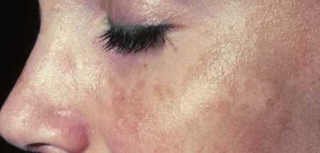"Melasma" Cause And Cure