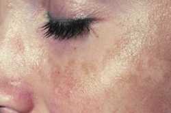 \"Melasma\" Cause and Cure
