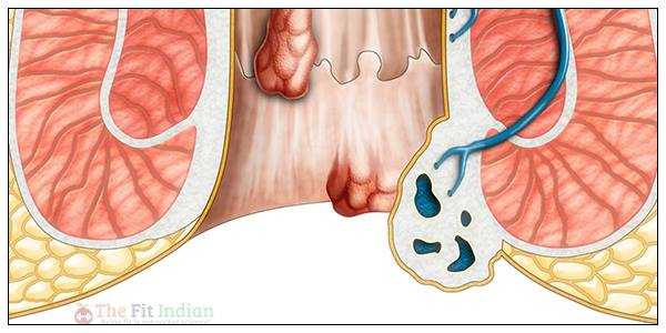 बवासीर का आयुर्वेदिक डॉक्टर : Piles Doctor In Bhopal Indore