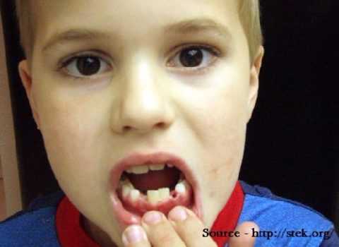 à¤ªà¤¾à¤¯à¤°à¤¿à¤¯à¤¾ à¤à¤¾ à¤°à¤¾à¤®à¤¬à¤¾à¤£ à¤à¤²à¤¾à¤ | Pyorrhea Treatment In Hindi