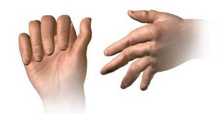 à¤¯à¥ Ayurvedic Treatment à¤ªà¥à¤°à¤¾à¤¨à¤¾ à¤¸à¥ à¤ªà¥à¤°à¤¾à¤¨à¤¾ Gathiya à¤°à¥à¤ à¤­à¥ à¤à¥ à¤¸à¥ à¤à¤¤à¥à¤® à¤à¤°à¤¤à¤¾ à¤¹à¥