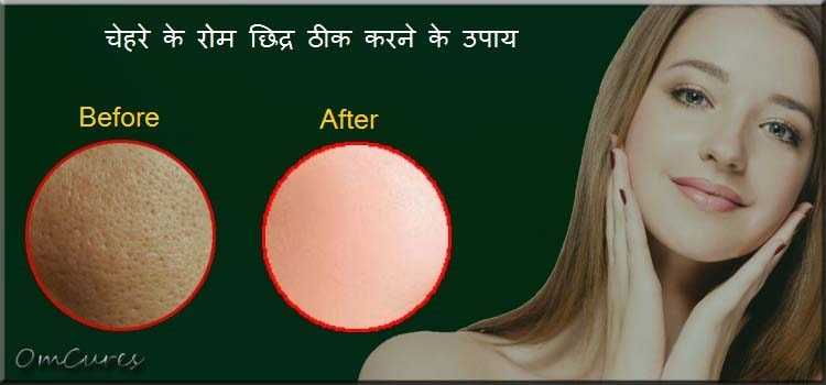 रोम छिद्र भरने के उपाय | चेहरे के रोम छिद्रों से छुटकारा पाने के Best घरेलु उपाय