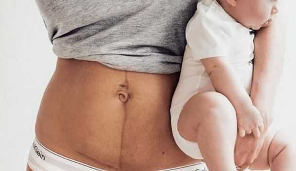 10 Home Remedies For C-Section Recovery; Post-C-Section Tips