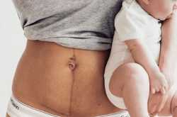 10 Home Remedies for C-Section Recovery; Post-C-Section Tips