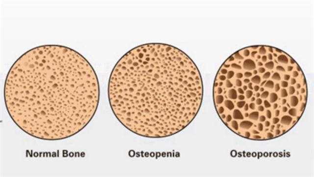 10 Home Remedies For Osteopenia To Treat And Prevent It Naturally