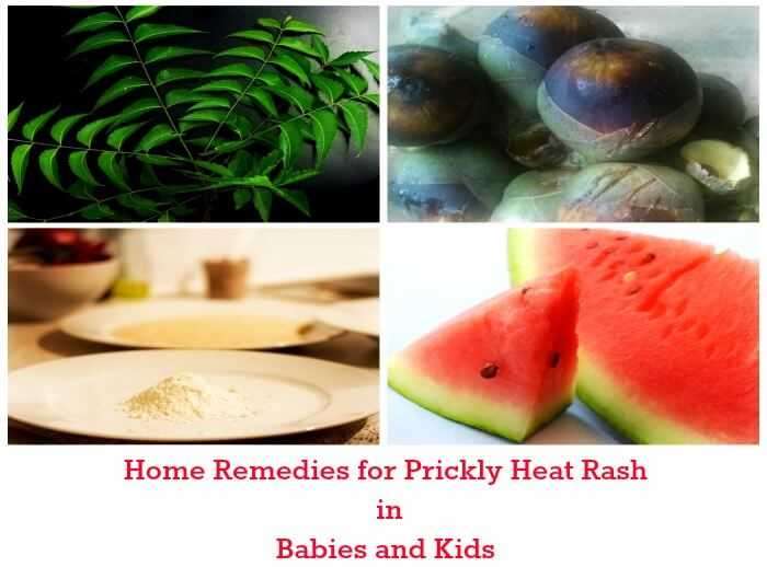11 Ways To Get Rid Of Prickly Heat Rash Once And For All