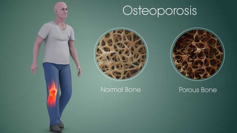 13 Effective Home Remedies For Osteoporosis
