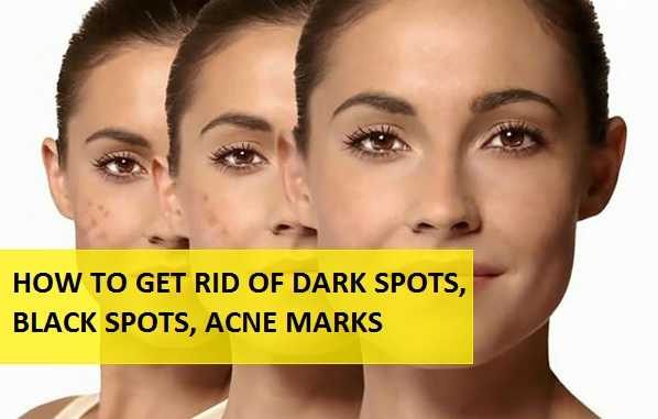 16 Best HomeRemedies For Dark Spots And Black Spots: (Ultimate Guide)