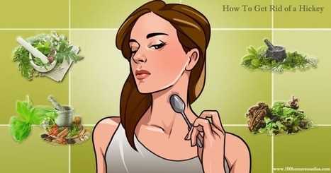 3 Best Remedies To Get Rid Of Hickey Fast - NiceStyles