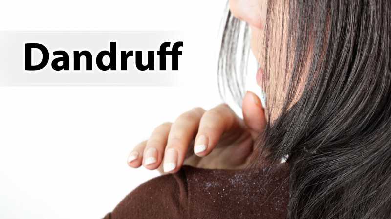 4 Best DIY Hacks For Dandruff Removal - Say NO To Dandruff