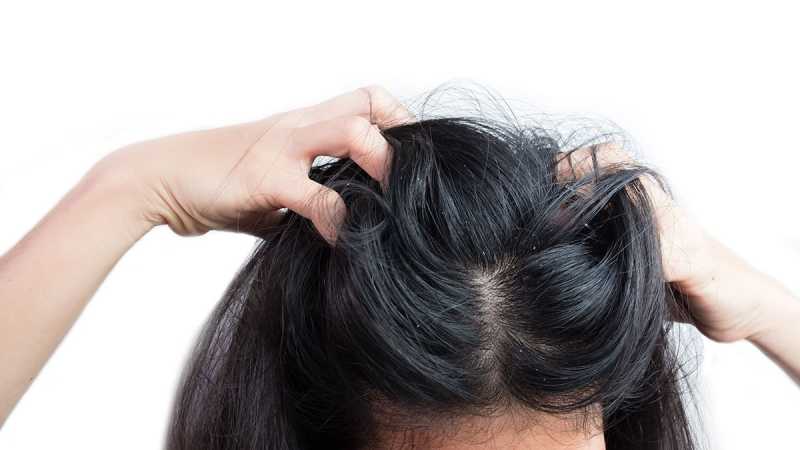 6 Effective Home Remedies For Itchy Scalp