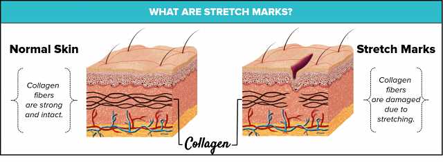 6 Organic Tips To Beat Those Unwanted Stretch Marks