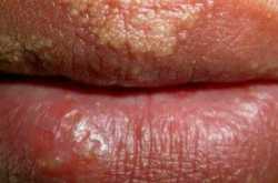 7 Best Home Remedies for Fordyce Spots That Are Worth Giving A Try