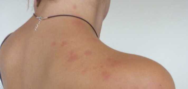 7 Home Remedies For Dust Mite Bites Gathered From Kitchen Ingredients