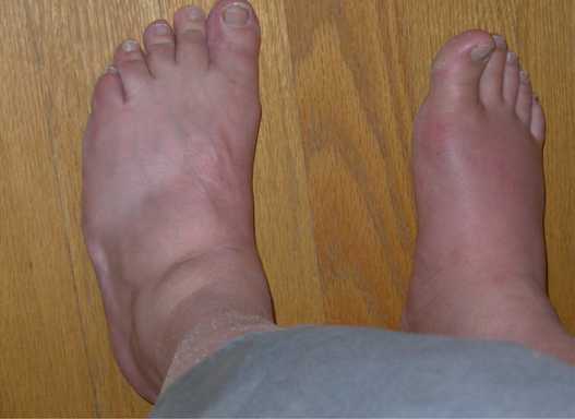 8 Effective Home Remedies For Uric Acid - Lifestylica