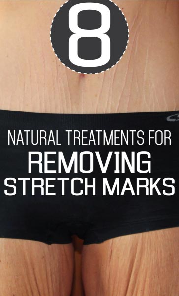 8 Natural Treatments For Removing Stretch Marks