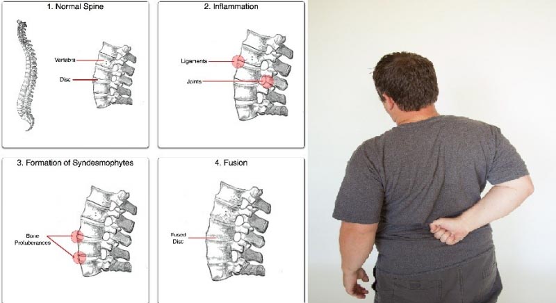 9 Best Ankylosing Spondylitis Treatment In Homeopathy - Doctor Curex