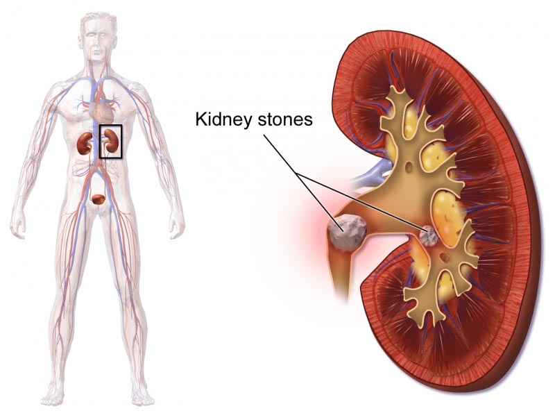 9 Best Food For Kidney Stone Removal- Kidney Stone Diet Chart