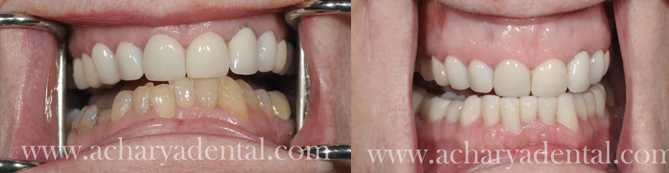 A Brand New Smile At Acharya Dental Withnin 24 Hours With Teeth