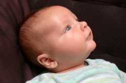 A Brief Overview Of Baby Acne - How to Get rid of acne Blog