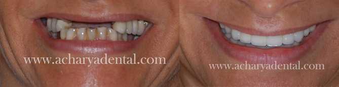 A HAPPY SMILE | Acharya Dental