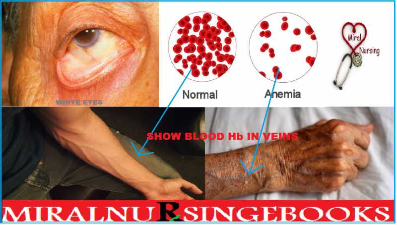 ANEMIA à¤à¤¨à¥à¤®à¤¿à¤¯à¤¾