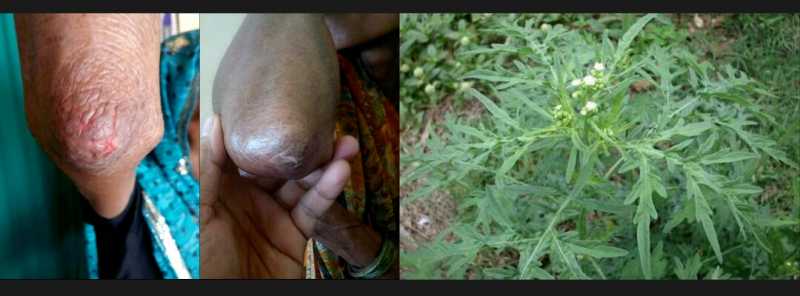 Airborne Contact Dermatitis Homeopathic Treatment Success Story