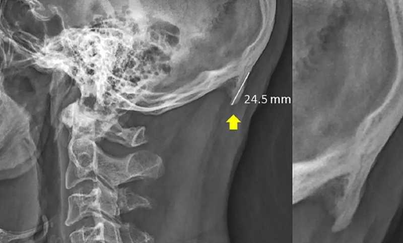 Are Horns Growing On Youngsters Due To Excess Cellphone Usage?