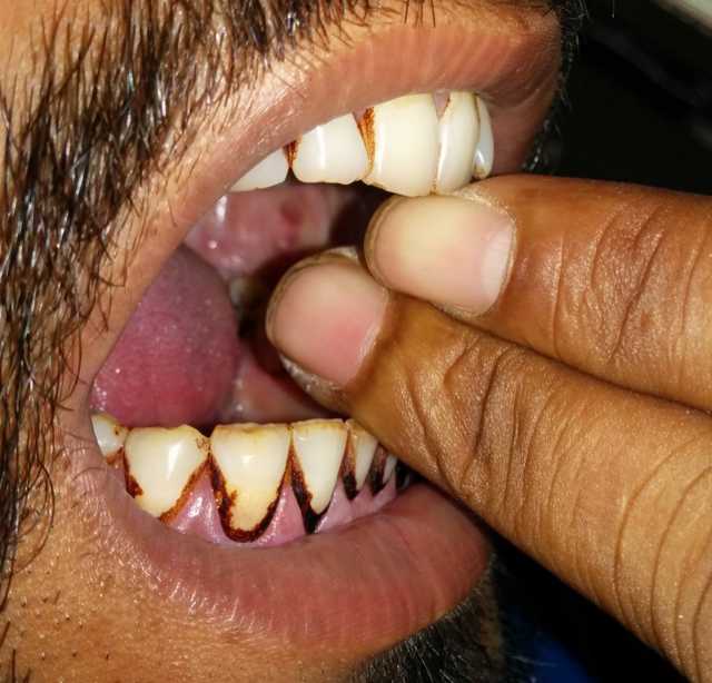 Areca Nuts- Smokelss Tabacco Play Havoc With Young Lives