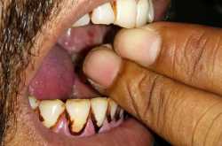 Areca nuts- Smokelss tabacco play havoc with young lives