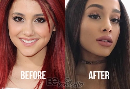 Ariana Grande Plastic Surgery REVEALED! Before And After 2018