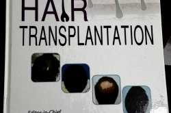 authouring 2 chapters in hair transplantation book