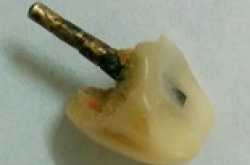 Avoid going to Unqualified Chinese Dentists