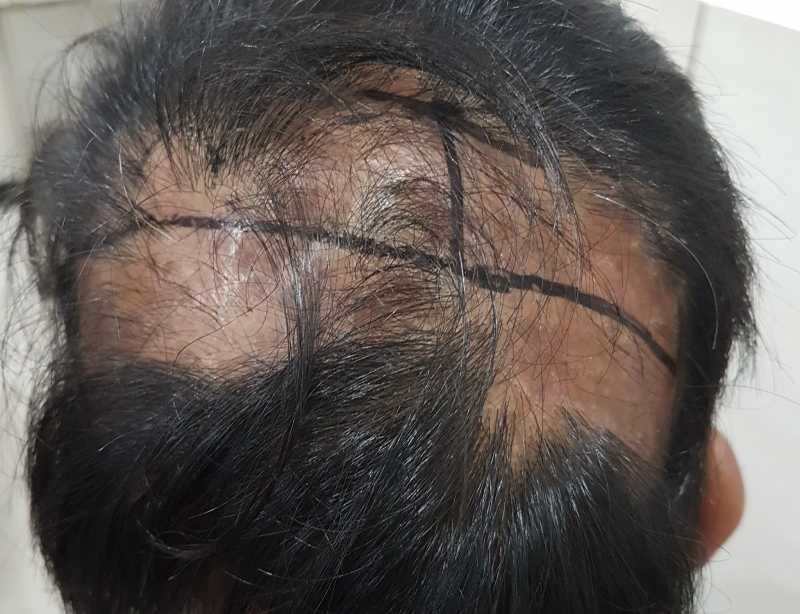 BODY HAIR TRANSPLANT:BODY HAIR AS DONOR