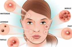 Battle your Acne Problems with the Best Skin Specialist -