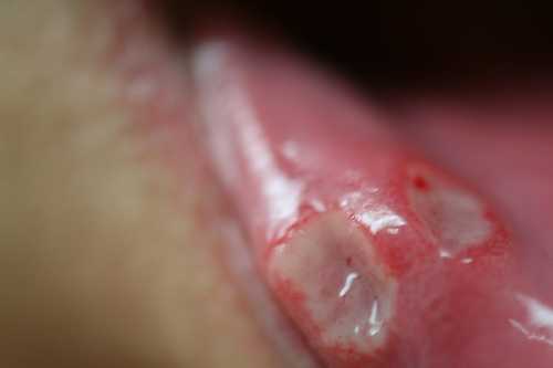Canker Sores Home Remedies