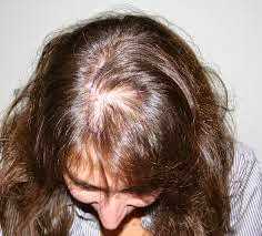 Causes Of Baldness In Women