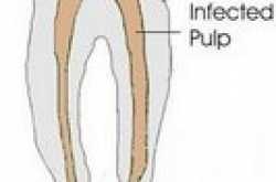 Causes of Tooth Abscess
