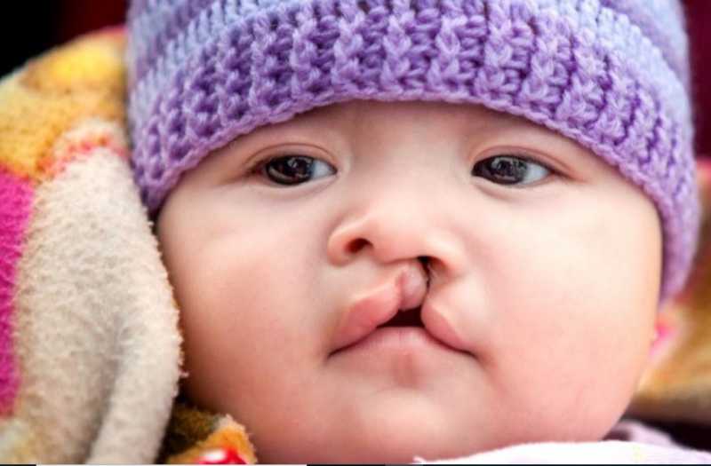 Cleft Awareness And The Importance Of Folic Acid - Sindhujp