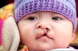 Cleft awareness and the importance of folic acid - Sindhujp