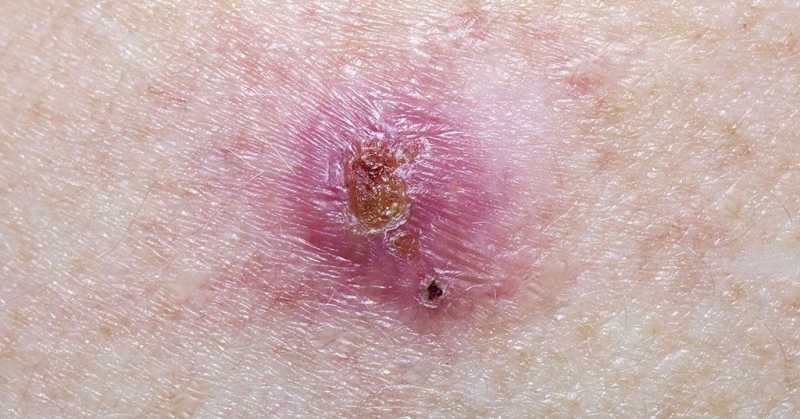 Common Skin Cancer Can Signal Increased Risk Of Other Cancers