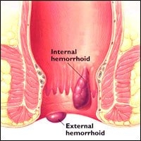 Constipation And Hemorrhoids