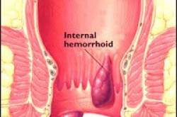 Constipation and Hemorrhoids