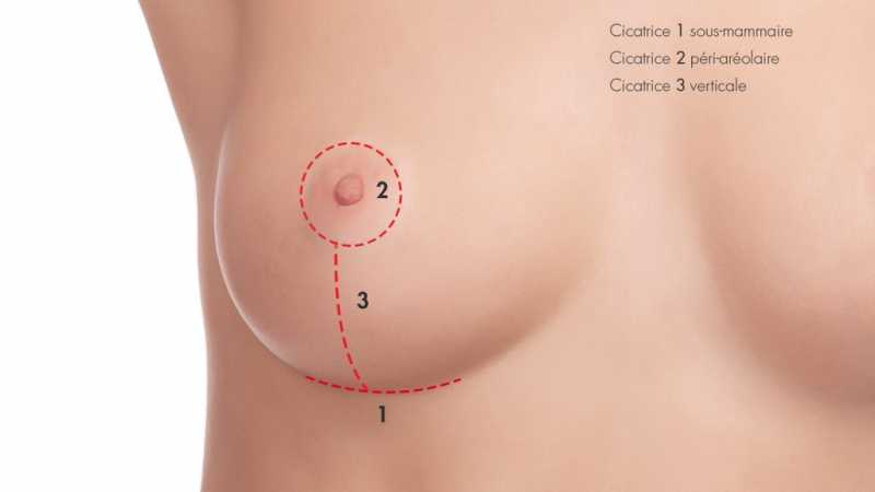 Cost Of Breast Reduction Surgery In Nigeria » Lightup Info